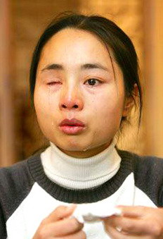 Xia Hongyu, a resident of Lichuan in Hubei province, relates how her ex-husband gouged out one of her eyeballs in December 2004.