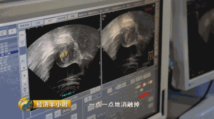 中国这一创举震撼全球:可用超声波迅速消融肿瘤