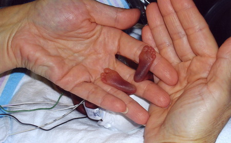 2007年2月20日，佛罗里达迈阿密一家儿童医院，世界最早产婴儿艾米莉泰勒将出院，她在母亲体内里仅待了大约4个多月时间。图为2006年10月24日泰勒出生后她的小脚与成人手的对比。