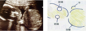 图解怀孕中期b超图片(13-24周)