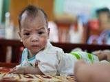 越南'橙剂'致残儿童 受害者缺胳膊少腿浑身溃烂[组图]