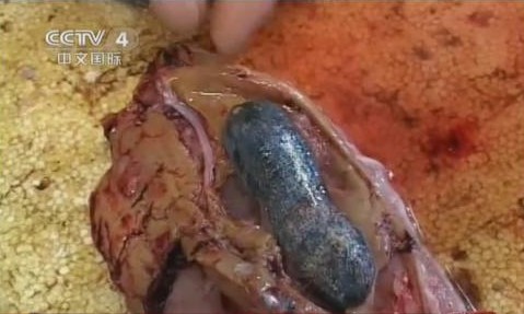 福建:男子生吞鱼胆中毒险丧命