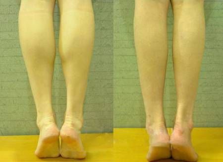 2个月瘦腿经验分享 <em>女孩子肌肉</em>腿速变小鸟腿-