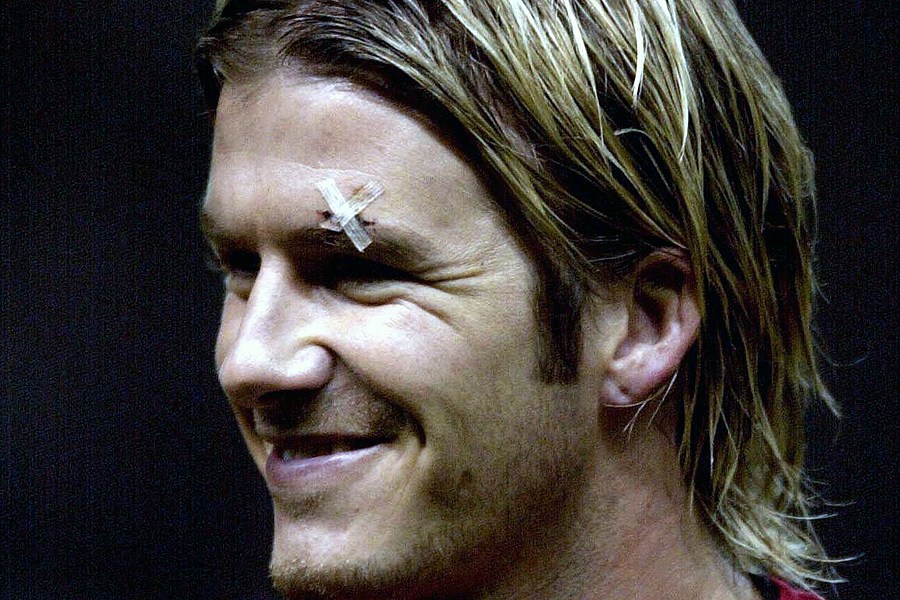 2003年2月19日，曼彻斯特，贝克汉姆出战尤文图斯，贝克汉姆眉骨还留下被弗格森飞鞋击中的伤疤。 