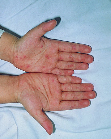 患手足口病别大意 三岁儿童引发脑膜炎