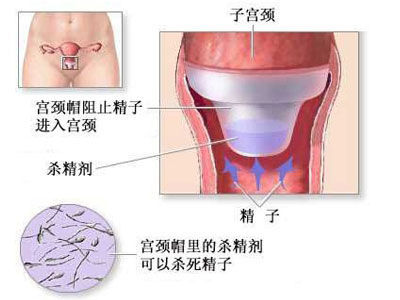 女性避孕全程 解析从阴道到子宫(图)
