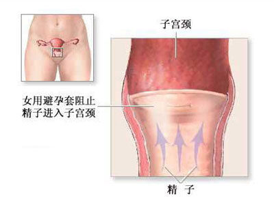 <em>女性</em>避孕全程 解析从<em>阴道</em>到子宫(图) _ 中国网