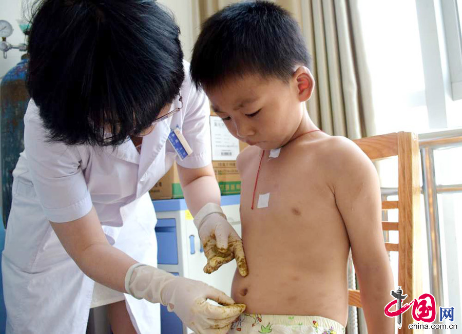 2015年7月13日，“初伏”首日，河南省汝南縣人民醫院一位小朋友在貼敷“三伏貼”。