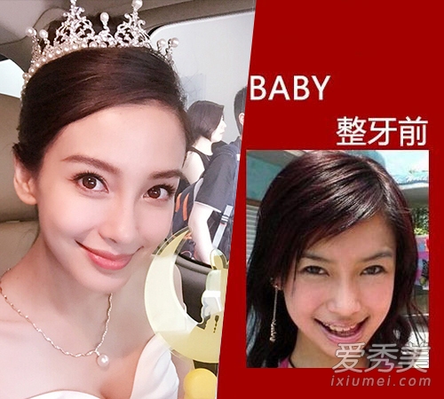 娱乐圈其他明星也受到了影响,baby曾说自己容貌变化是矫正牙齿造成的