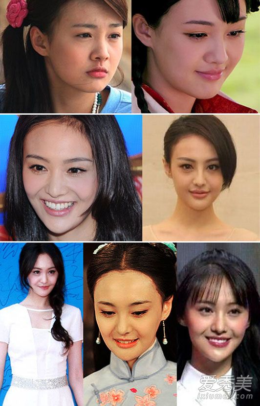 明星素人下巴整形失败案例 下巴歪斜长硬块