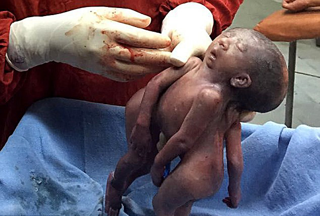 印连体婴共用一张脸 出生6分钟后夭折