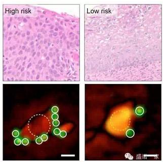 海外医疗新神器,智能手机也能进行肿瘤诊断