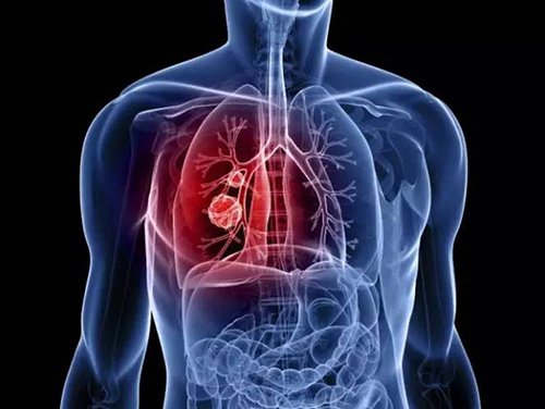 全球肺癌关注月:早期无明显症状 定期体检筛查