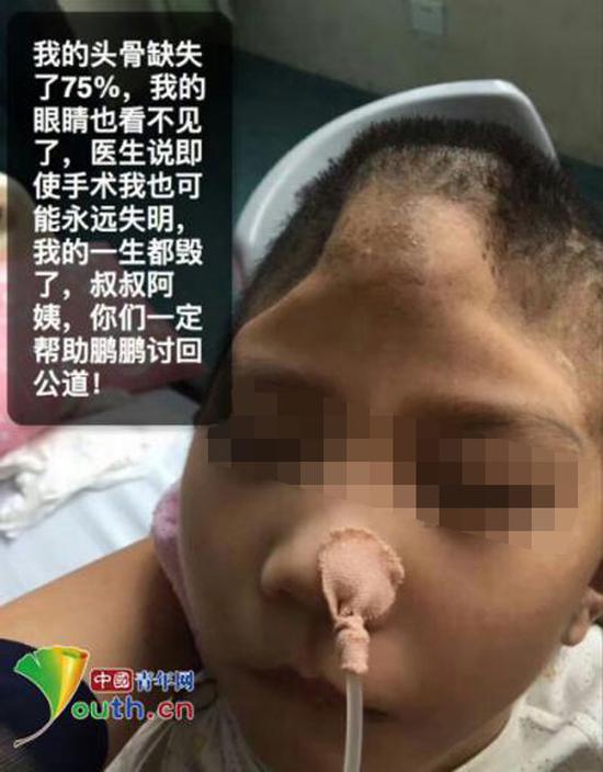 被虐待男童头骨损失75%，眼睛也看不见了。 @呼唤鹏鹏 图