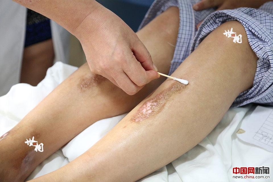 白淑芳为安徽一位患者双腿涂抹药膏.