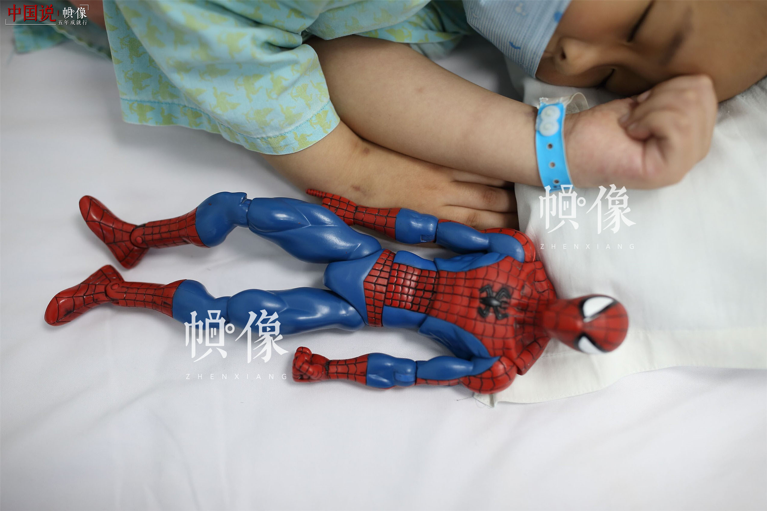 2017年5月24日，北京首都儿科研究所，天佑把“蜘蛛侠”玩具放在身边，躺着睡觉。天佑得的是急性淋巴细胞白血病B型，这种类型的白血病治愈率很高的，有六七成把握。随着医学发展，白血病已经不是不治之症，通过化疗、造血干细胞移植等治疗措施，80%-90%的儿童白血病可以缓解，60%-70%的可以治愈。中国网记者 陈维松 摄