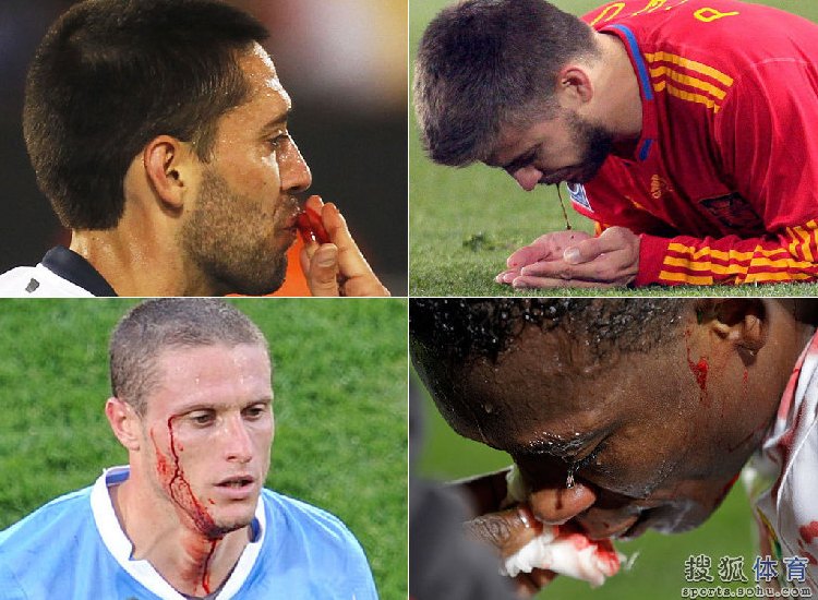 Coupe du Monde:Photos de joueurs blessés