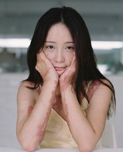 Une jeune femme défigurée par des brûlures affronte son horrible passé avec courage