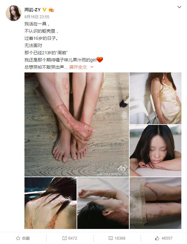 Une jeune femme défigurée par des brûlures affronte son horrible passé avec courage