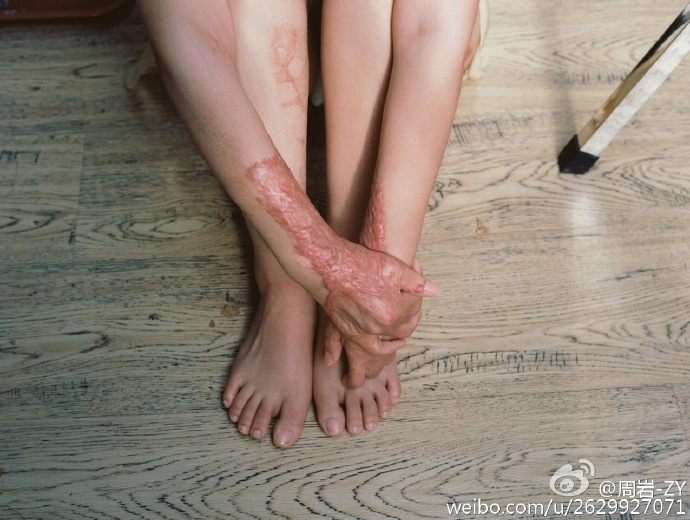 Une jeune femme défigurée par des brûlures affronte son horrible passé avec courage