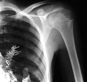 Nachdem sieben Chinesinnen aus einer Lackfabrik dauerhafte Lungensch?den erlitten haben, wird erstmals in einem Bericht die Gefahr der Nanotechnologie für den Menschen aufgezeigt. In den Farben der Fabrik wurden Nanopartikel genutzt, und die Frauen arbeiteten ohne Atemschutz.