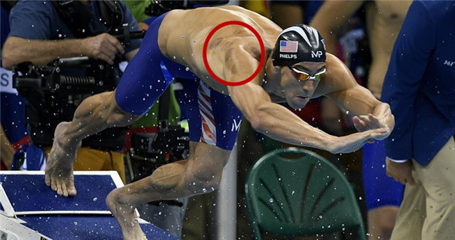 Die Schröpfabdrücke von Phelps: Der 19fache Goldmedaille-Besitzer liebt TCM