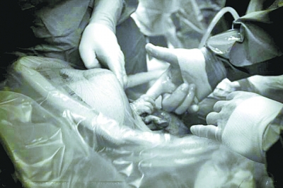 妊婦 流出 子宮から手を伸ばして医者の指を掴んだ帝王切開の赤ちゃん！_ ...
