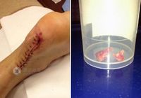 Ужасная рана на ноге Лю Сяна после снятия швов