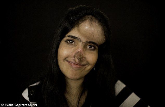 Афганка с отрезанным носом после косметической операции