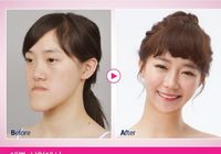 Удивительно! Китайская девушка изменила внешность через пластику в Южной Корее 