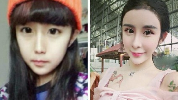 До и после пластики: история превращения 15-летней китайской девушки