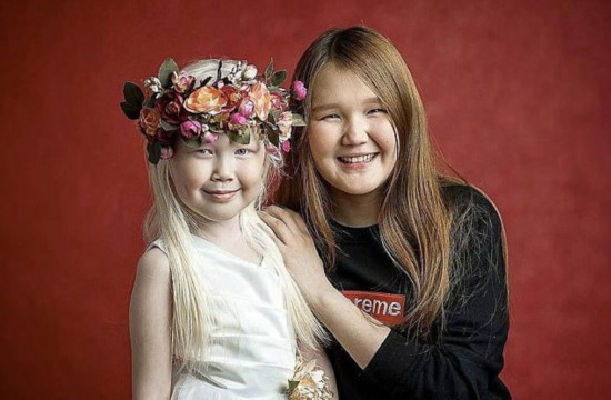  С детства она страдает от альбинизма – у малышки серебристо-белые волосы и чисто-белая кожа, как у фарфоровой куклы. 