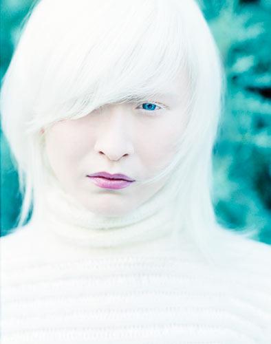 albinismo 1