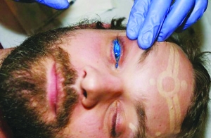 Un atrevido hombre canadiense recibió un tatuaje en el globo ocular con 40 pinchazos 