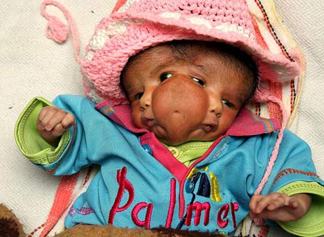 Un bebé nacida con dos caras considerada como una diosa en India 1