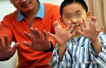 Niño con 31 dedos de la mano y del pie preparado para operación 1