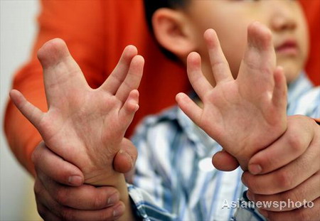 Niño con 31 dedos de la mano y del pie preparado para operación 2