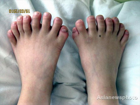 Niño con 31 dedos de la mano y del pie preparado para operación 3