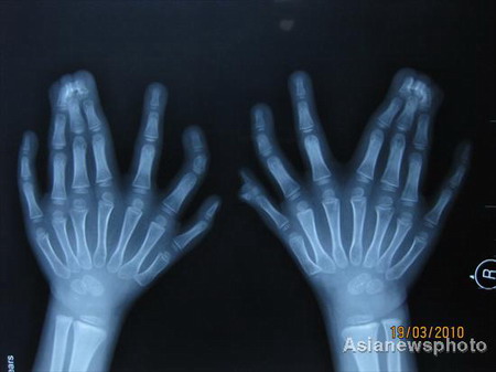 Niño con 31 dedos de la mano y del pie preparado para operación 4