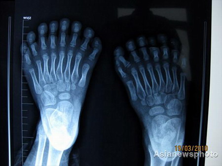 Niño con 31 dedos de la mano y del pie preparado para operación 5