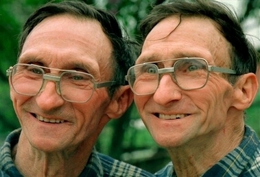 Los 10 casos de gemelos más extraordinarios del mundo 2