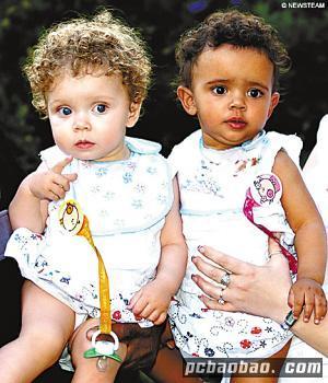 Los 10 casos de gemelos más extraordinarios del mundo 8