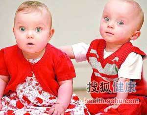 gemelos más extraños del mundo 5