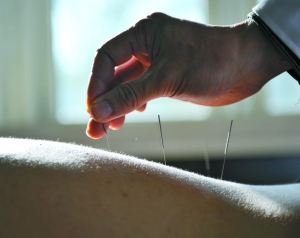 medicina tradicional china, acupuntura