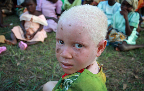 Sufren matanza los albinos africanos 6