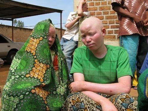 Sufren matanza los albinos africanos 9