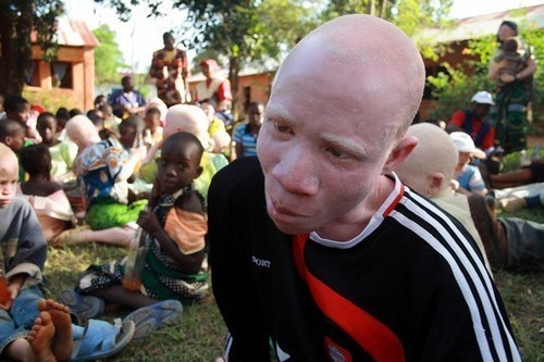 Sufren matanza los albinos africanos 11