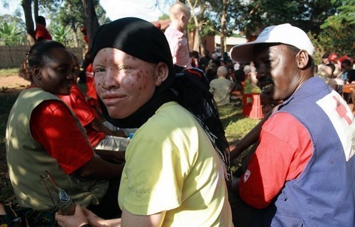 Sufren matanza los albinos africanos 12