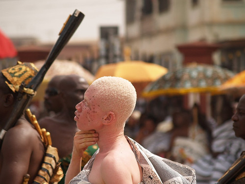 Sufren matanza los albinos africanos 13