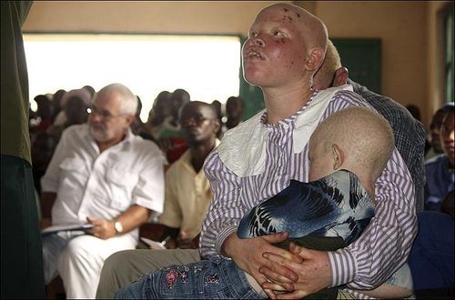 Sufren matanza los albinos africanos 15